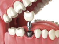 Advantage of Dental Implants